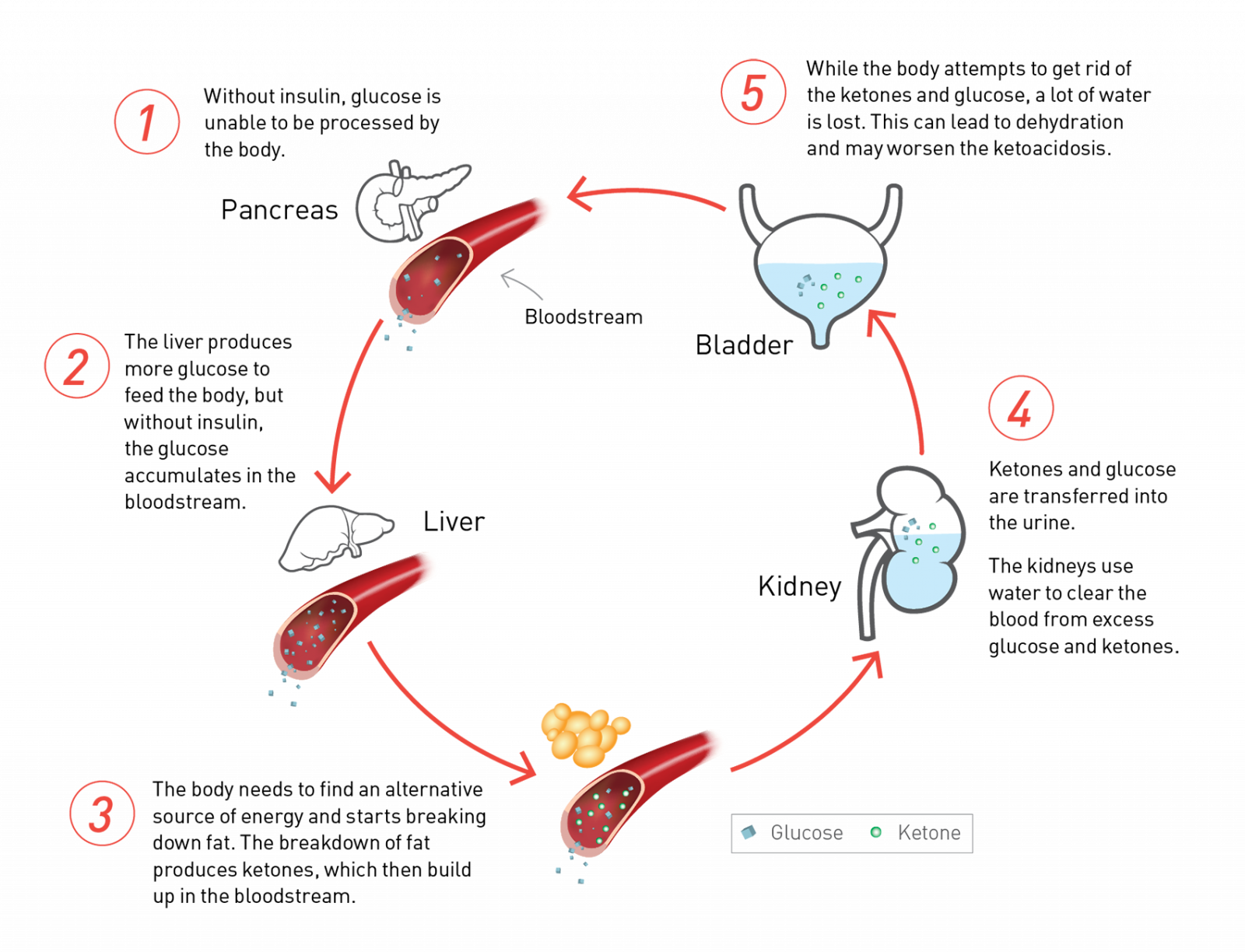 Diabetic ketoacidosis