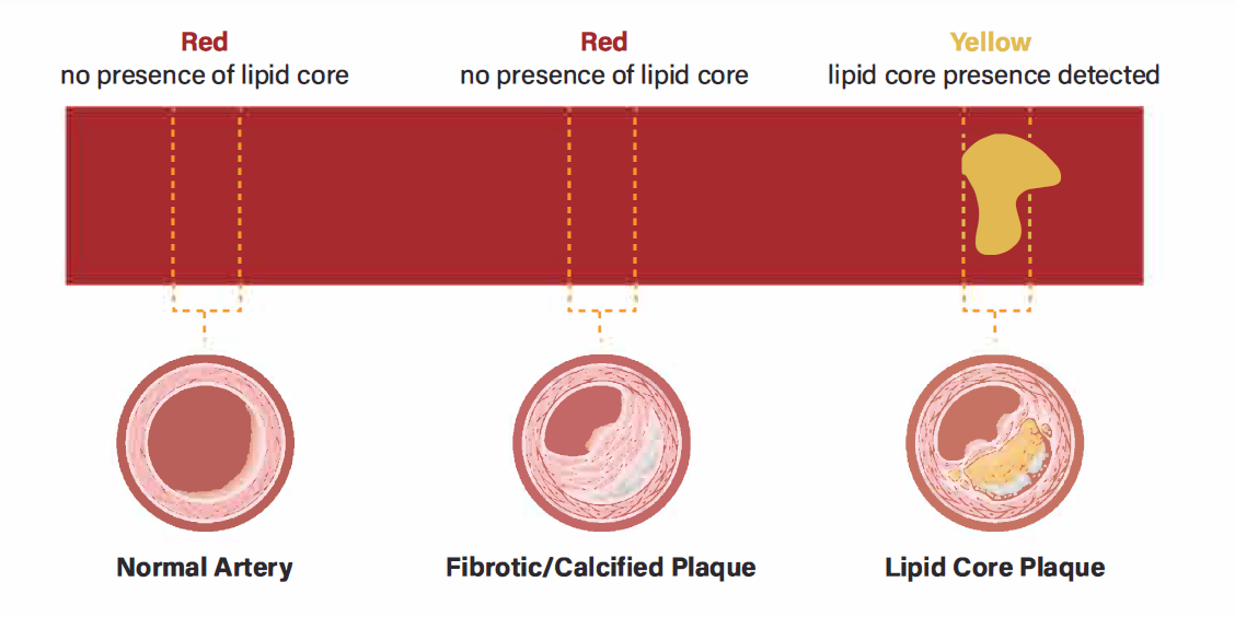 Proprietary Chemogram Displays Lipid Core Plaque